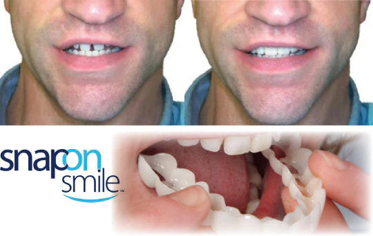 PROMOCION 2X1! Carillas Instantánea Snap-on Smile